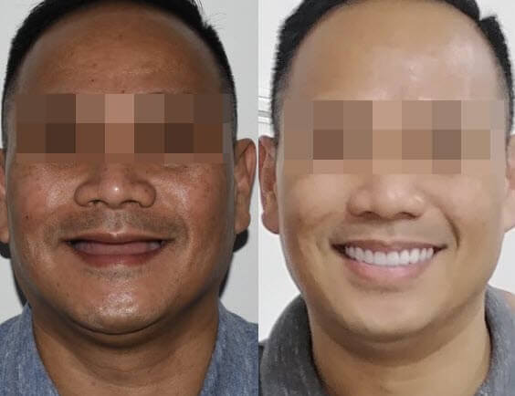 Before and after of All On 4 Dental Implants in Cancun.
