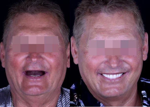 All on 4 dental implants before and after.