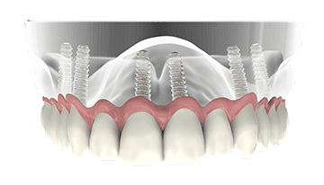 Full mouth dental implants.