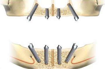 How do the implants work in your jawbone