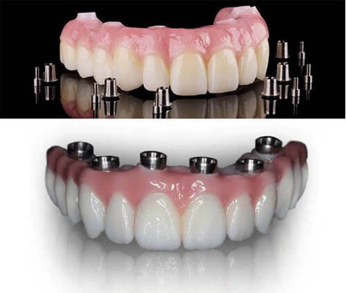 Zirconia Superstructure for the All On Fourmade in Cancun