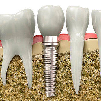 Dental Implants Mexico